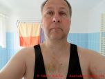 Weisheitszahn OP - Gesicht 13 Tage nach der Weisheitszahn OP