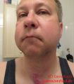 Mein Gesicht am 2. Tag nach der Weisheitszahn OP