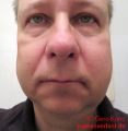 Weisheitszahn OP - 