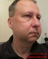 Weisheitszahn OP - 