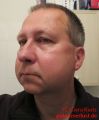 Weisheitszahn OP - 